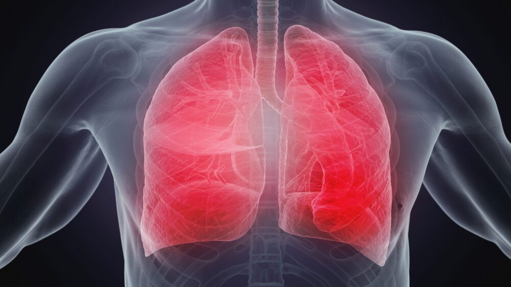 x-ray scan lungs